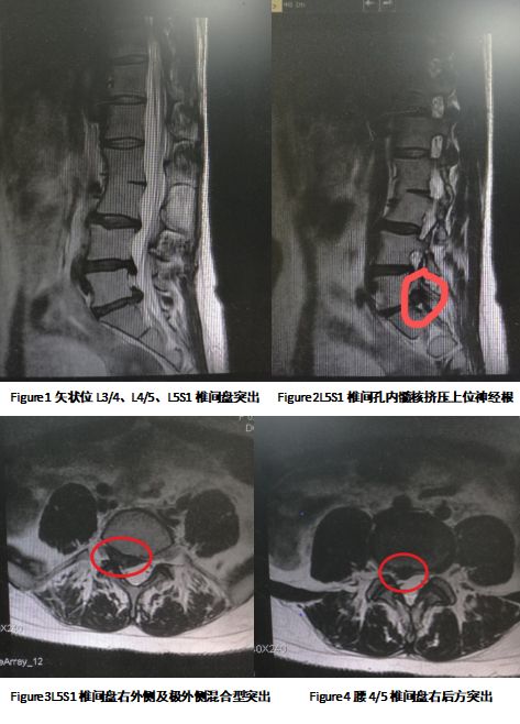 产后腰酸腿痛4年椎间孔镜手术巧解困扰