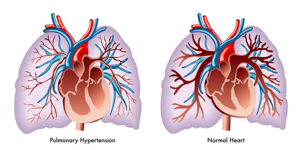 肺动脉压高怎么办