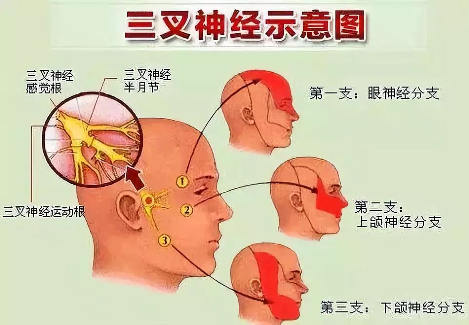 ▼ 看症状 患者疼痛位置单侧脸比较多见,恰好在眶上,口角上下三叉神经