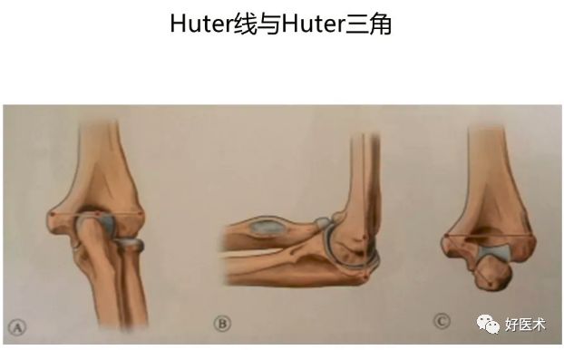 参考意义:手术过程中应避免内固定物进入以上三个窝,以免影响肘关节屈