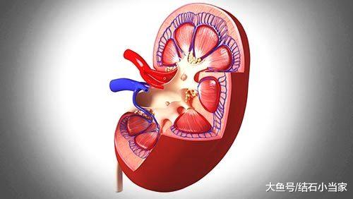 肾结石一般多久掉下来 f2277440369d46419d5d70508b3d8257.jpeg