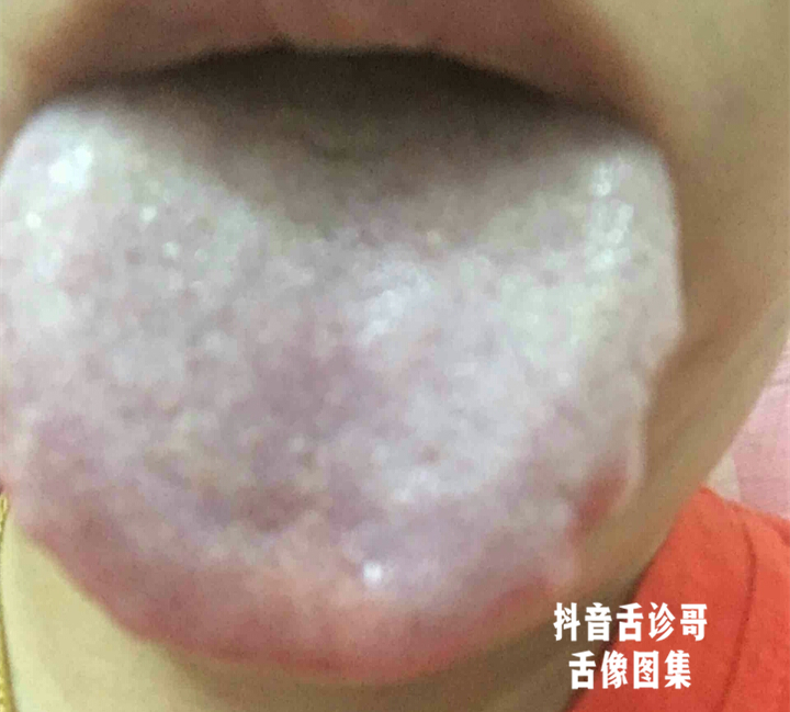 抖音舌诊哥:舌诊知健康,教你学会看舌象系列三十七