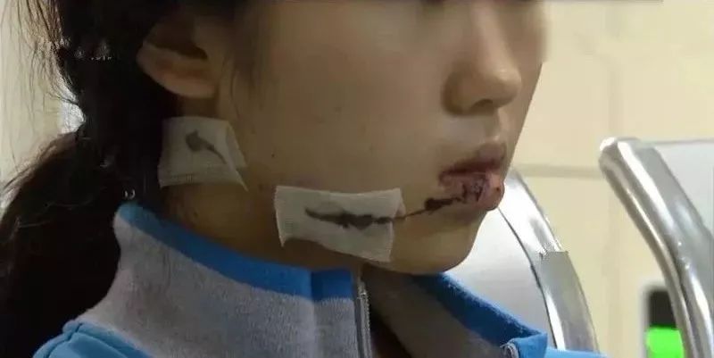 在深圳工作的15岁少女,因拒绝男子"求爱",脸被划数刀毁容!
