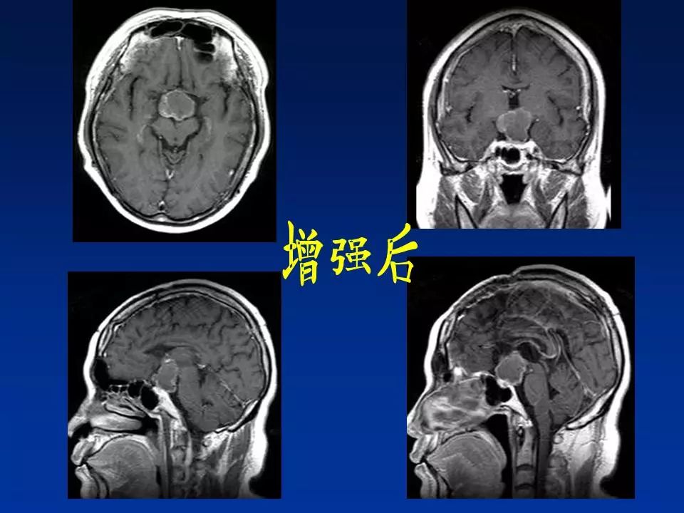 颅咽管瘤的影像诊断 | 影像天地