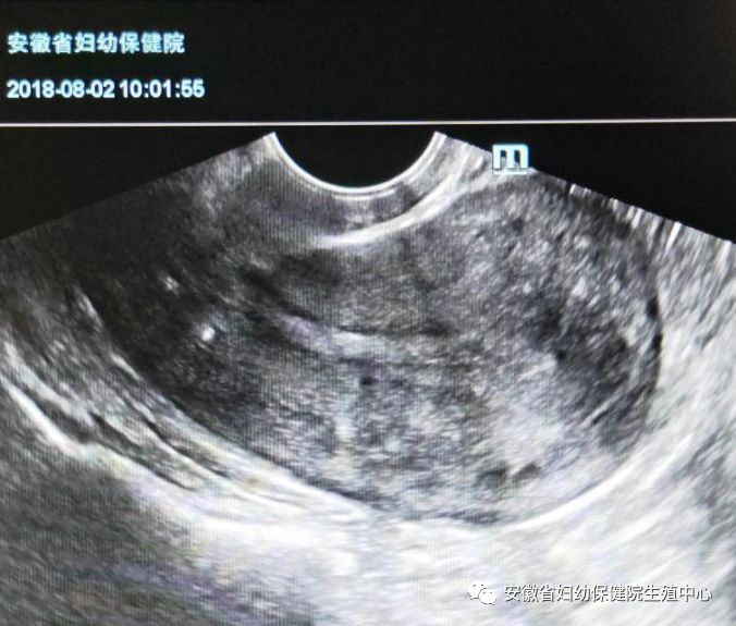 超声检查中子宫内膜的厚度,分型和血流的解读