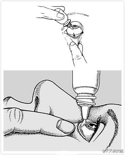 自己点眼药水的正确方法 2d39a9277a834a61b90eb509eaedfb19.jpeg