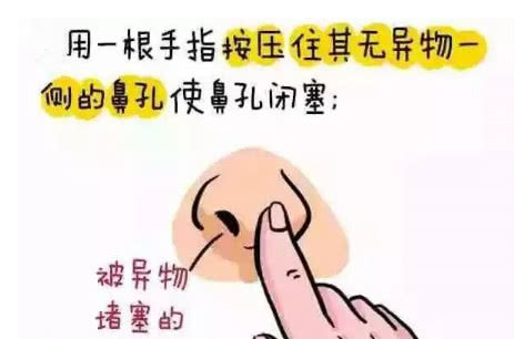                     2岁女童持续5天鼻子流血，医生竟从鼻腔里取出了“它”！