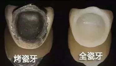 什么是连全瓷牙 509085c50cd044d1832a44e92868d226.jpeg