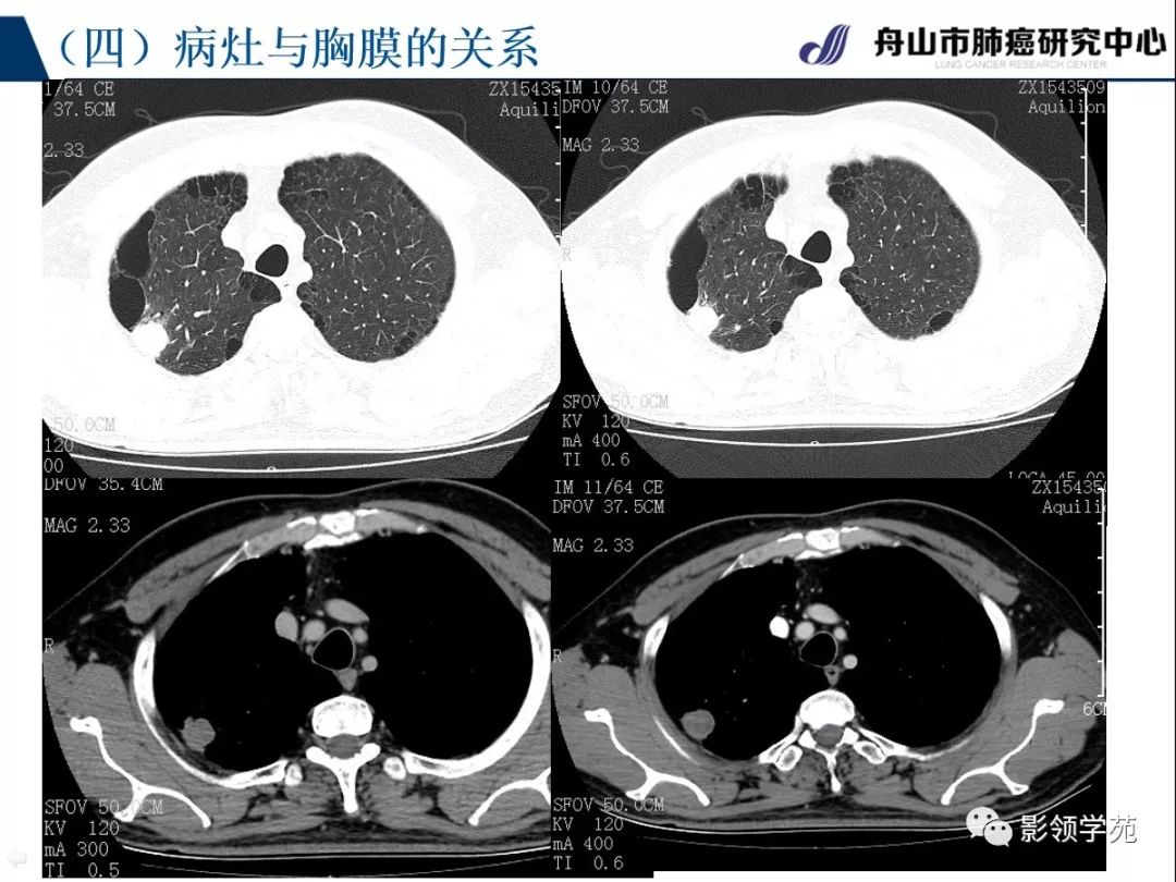 实性结节 叶间胸膜改变 宽基底 窄基底 直边征 胸膜增厚或凹陷 血管征