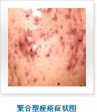 粉刺是什么病症 74b830f1fcfe40be8f1b03236c3534fc.jpeg