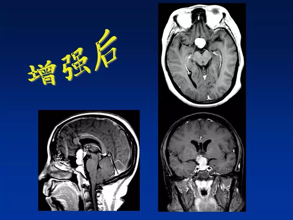 颅咽管瘤的影像诊断 | 影像天地