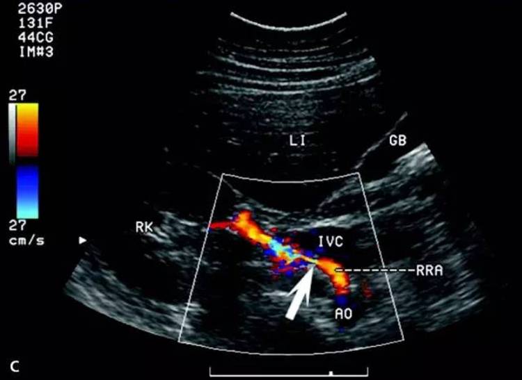 肾动脉狭窄:超声诊断难点和应对策略