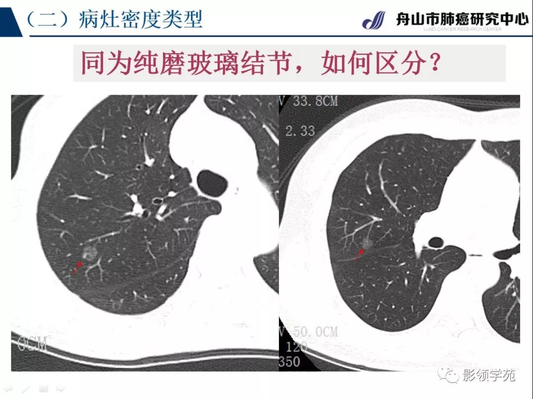 肺良恶性结节ct征象及鉴别诊断