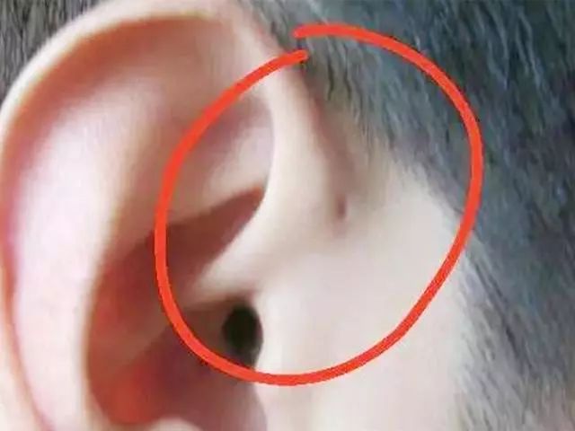                     孩子的耳朵天生就有小孔，是“福气”？父母别忽略，要重视