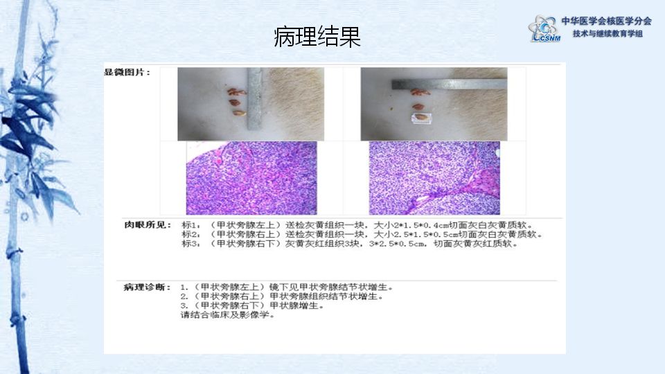 甲状旁腺显像的原理_甲状旁腺显像诊断甲状旁腺功能亢进症