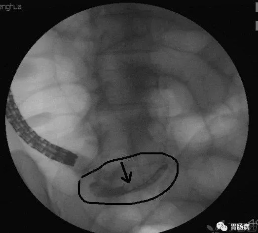 阑尾炎有什么办法 00b2280d0eb7430bbb0f004b65a88b18.jpg