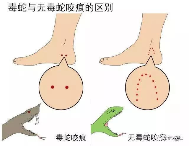 一大学生晚上在青秀山散步,竟被毒蛇咬伤.