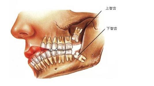 拔掉智齿后牙洞怎么办