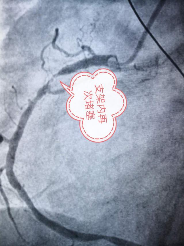 心脏支架堵了怎么办