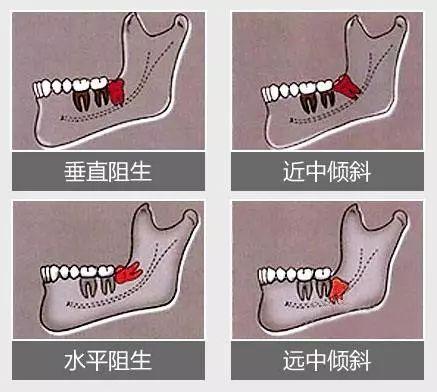 王诗龄换牙后美貌值倍增,智齿也长的太好了