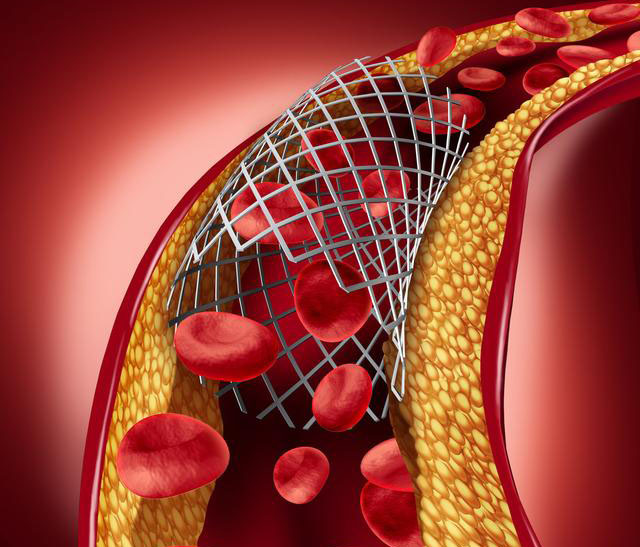 心脏支架堵了怎么办