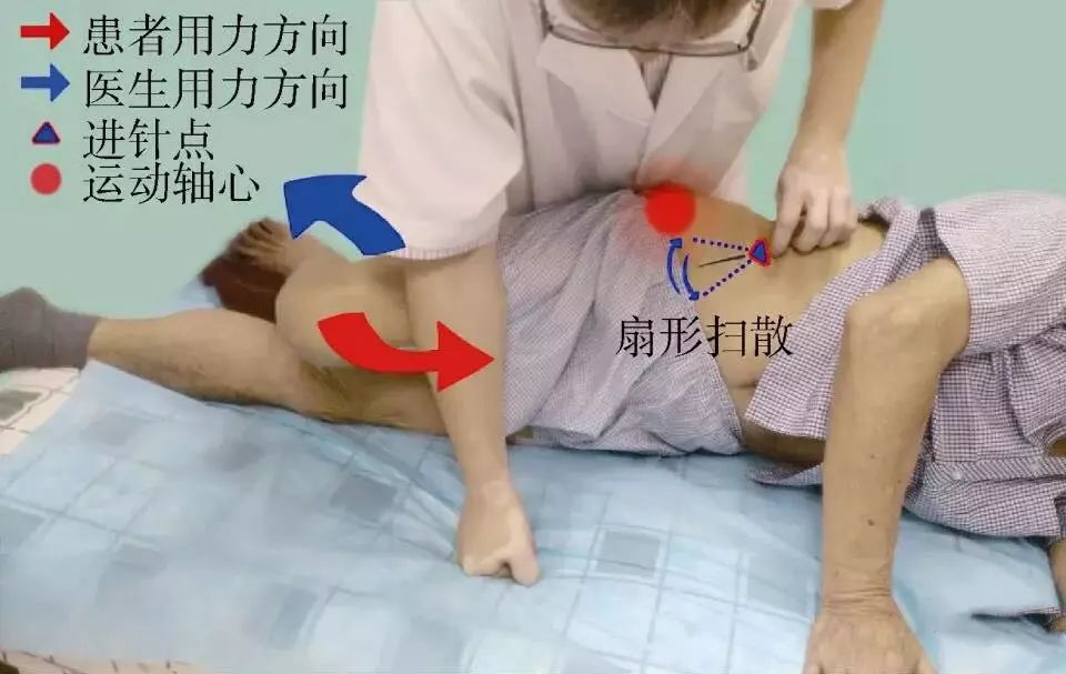 【医文医话】针灸科:中医针灸治腰肌劳损有奇效