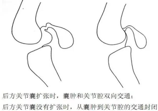 鉴别诊断 髌骨软骨软化 症状性膝关节折叠 髌骨不齐 脂肪垫综合征