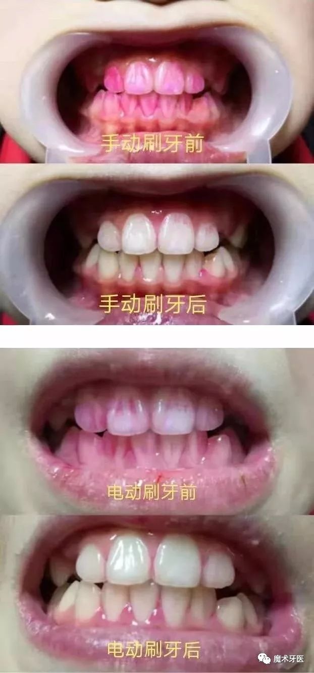 (图一:儿子的牙菌斑测试图片)