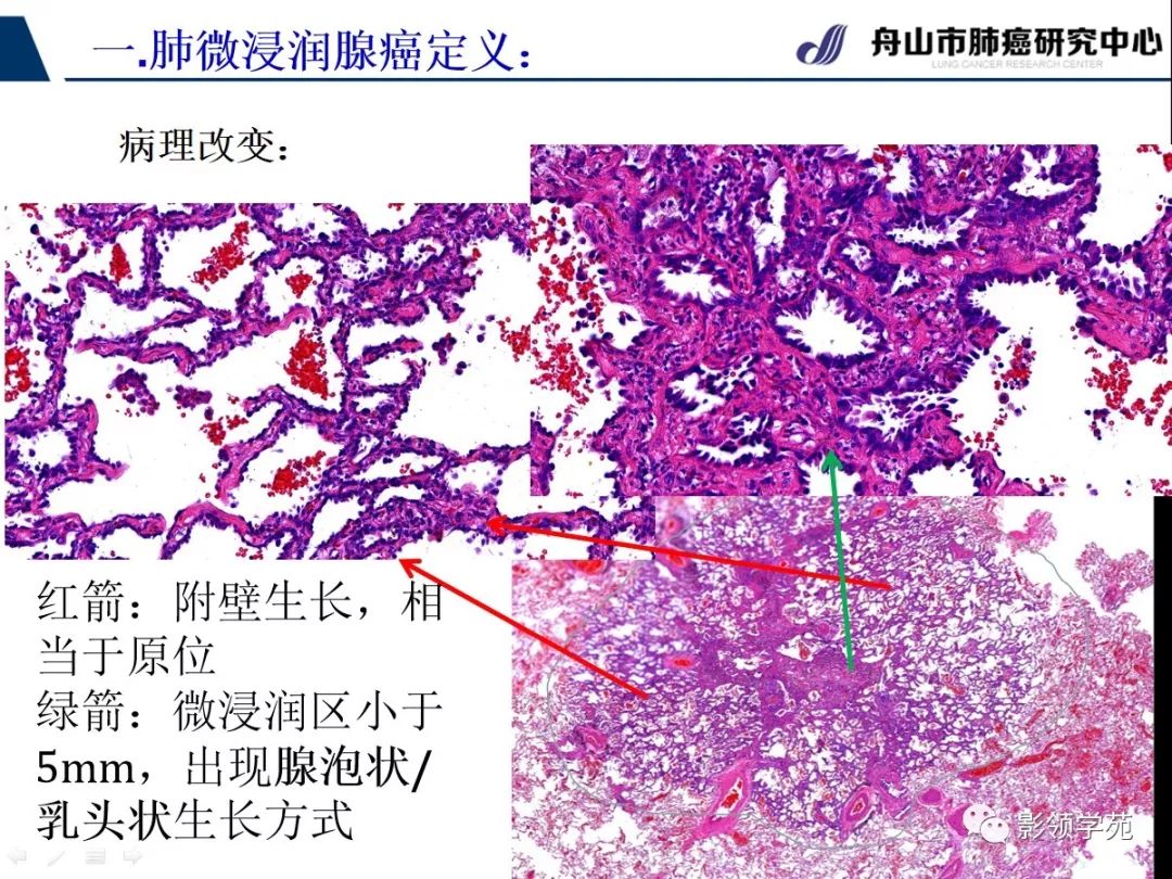 经典微浸润肺腺癌