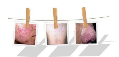 湿疹、荨麻疹、过敏的区别在哪?知道这几点,很