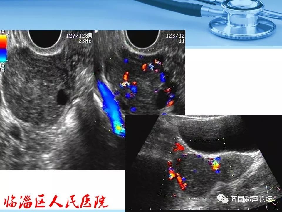 临医超声学堂卵巢肿瘤超声诊断