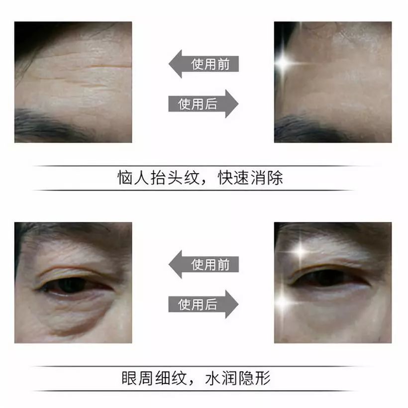 抬头纹怎么办教你一招 71044040f9bd431a9dbda0559a2761d1.jpeg