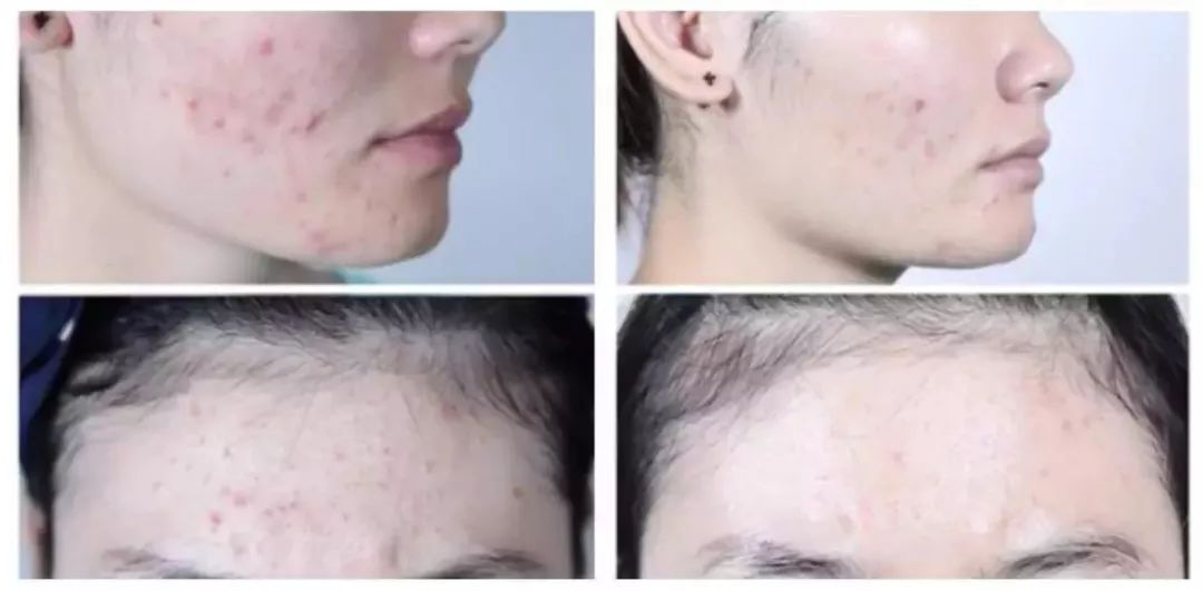 如何刷酸祛痘 78dc81123e53439bb2e4f03b24ddb9c0.jpeg