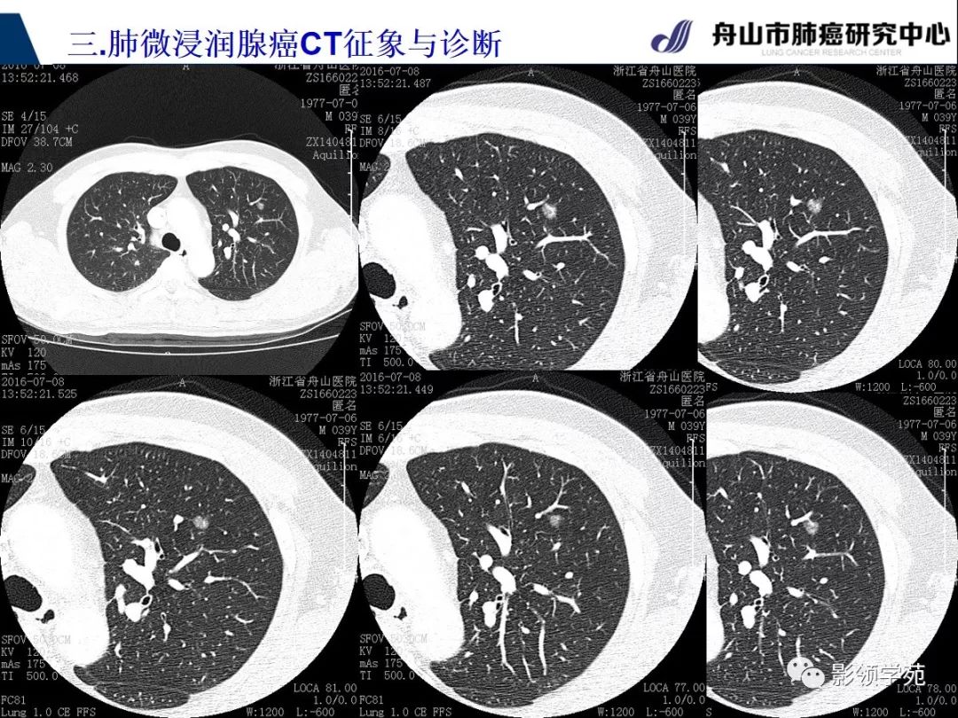 经典微浸润肺腺癌