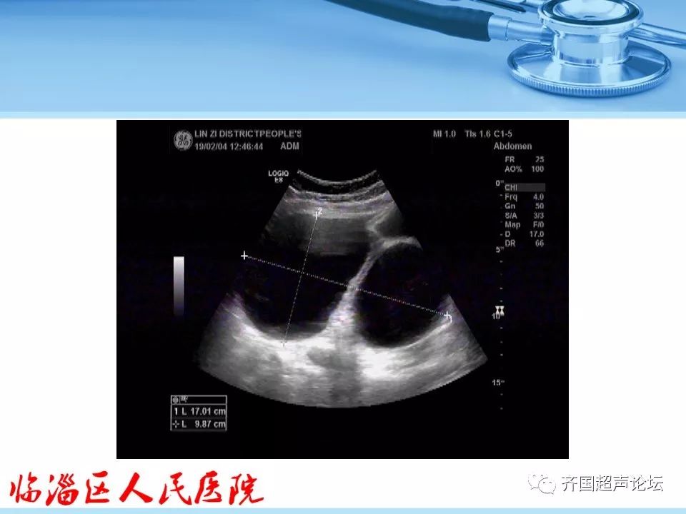 【临医超声学堂】卵巢肿瘤超声诊断