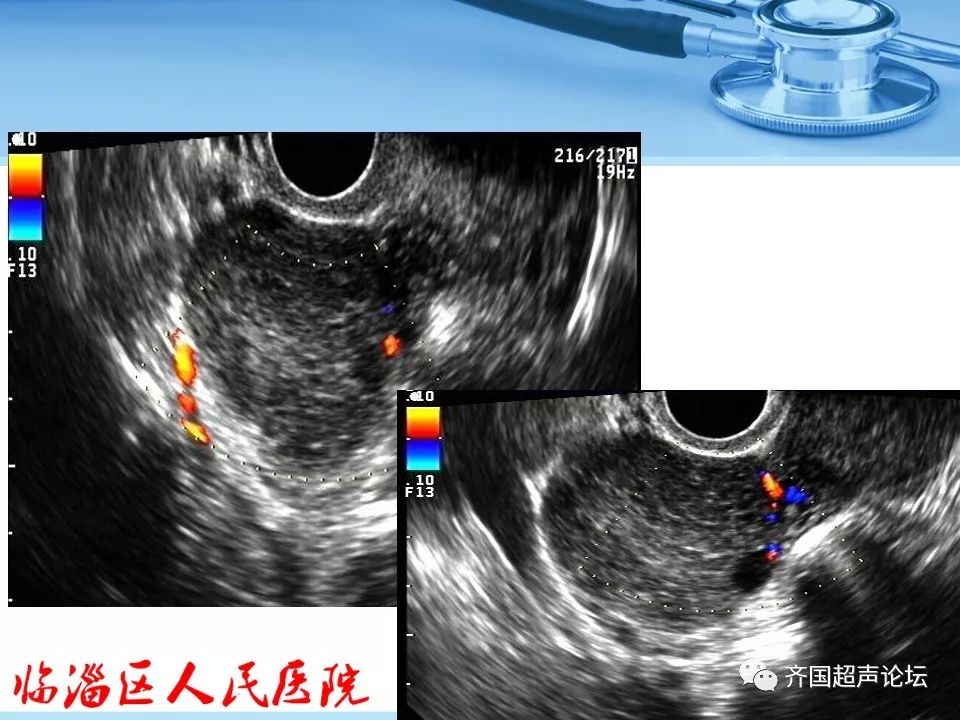 临医超声学堂卵巢肿瘤超声诊断