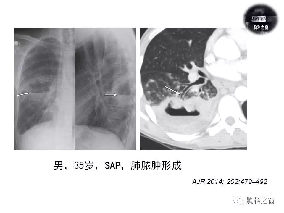 什么情况下要去检查肺 689380be02bc4d1ab645c6a271c01109.jpeg