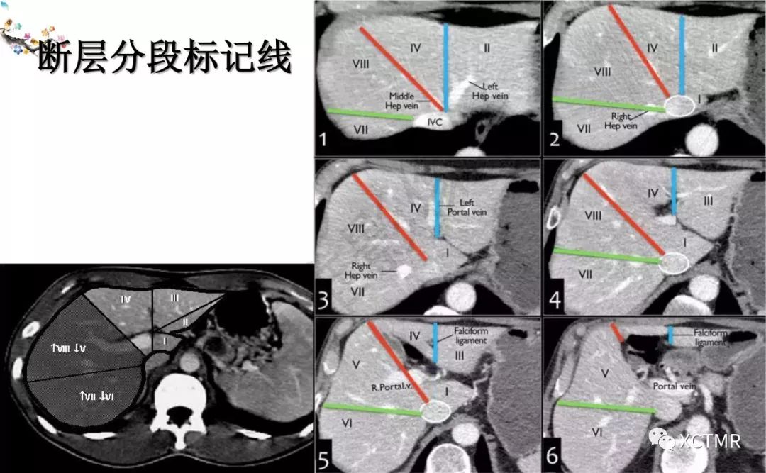 肝脏分叶分段的影像学解剖