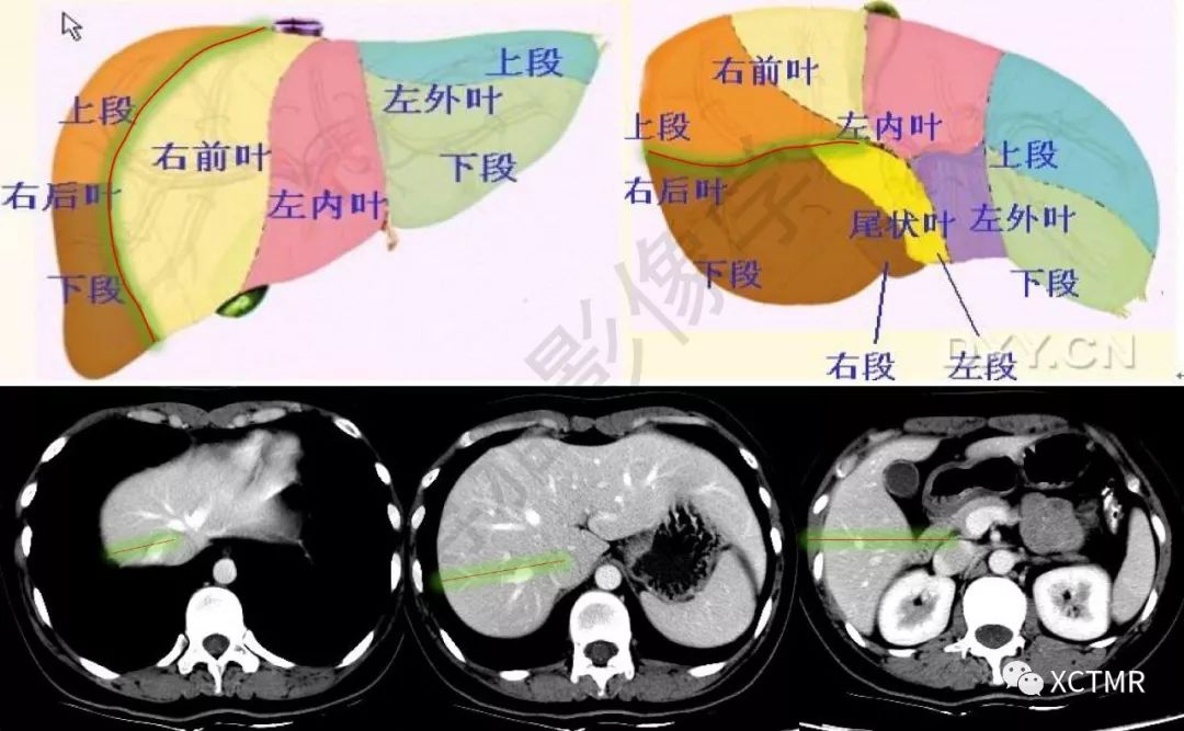 肝脏分叶分段的影像学解剖