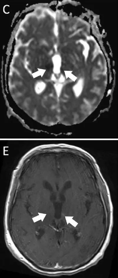 neurology:隐球菌脑膜炎伴急性卒中1例