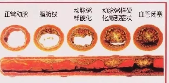 如何降低血液中胆固醇水平 1012d381a21b42fb8f3b59aefb5a3e77.jpg