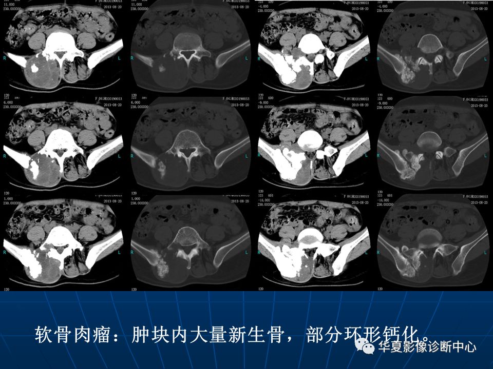 基础影像骶尾部脊索瘤影像诊断