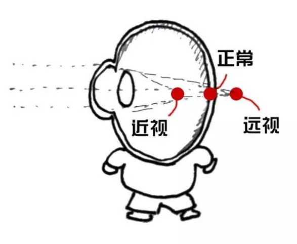 什么是远视眼?