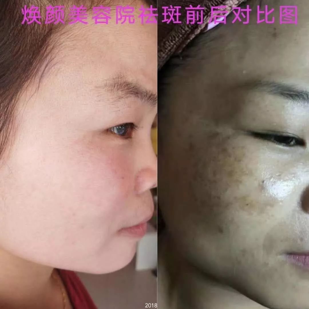 免费祛斑提取或祛痘提取1次 武宣超级商盟·商家推荐【焕颜美容院】