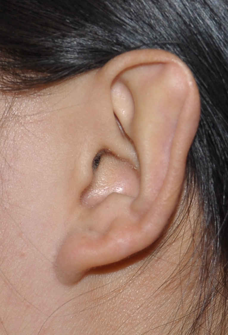 较罕见的stahl"s耳畸形的矫正 (原创)_耳轮