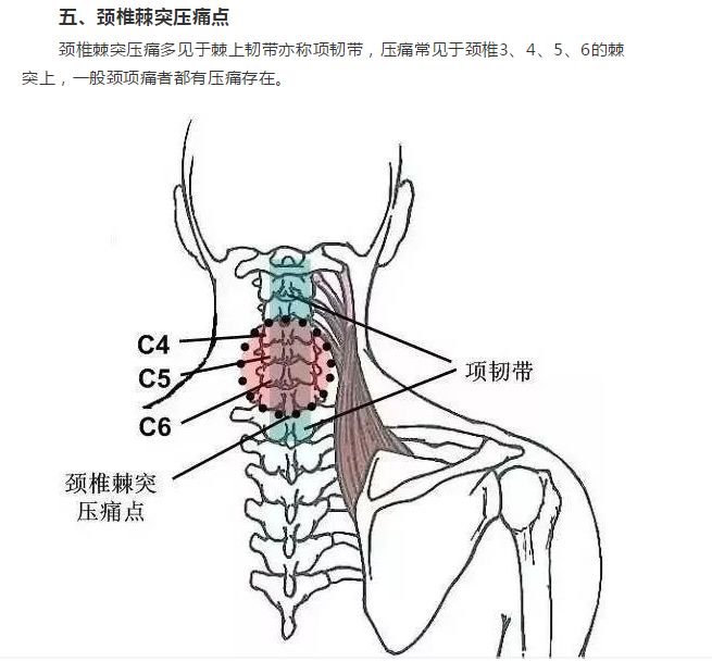 软组织常见压痛点