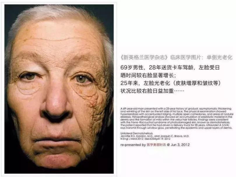 阳光中的紫外线照射皮肤上,不仅会形成各种强氧化作用的自由基,破坏