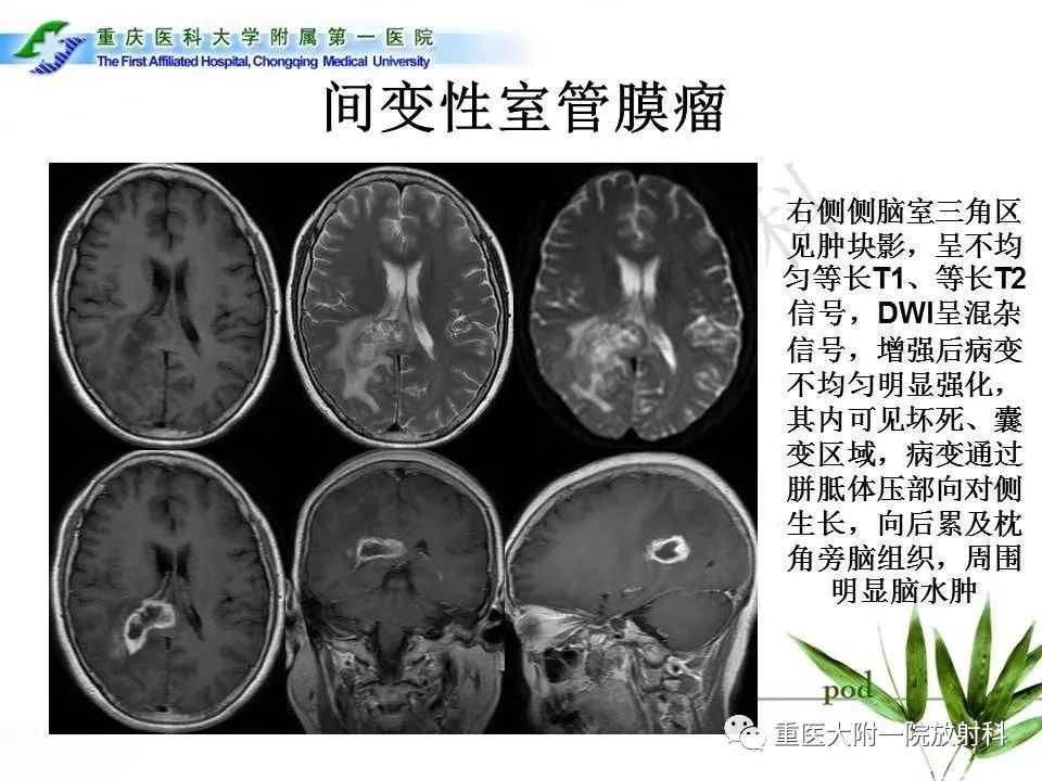 侧脑室常见肿瘤影像鉴别