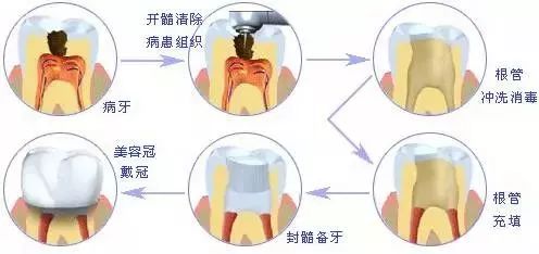 什么是牙髓炎引起的神经疼 4557f68c9dc649338a3d909cedddb41a.jpeg