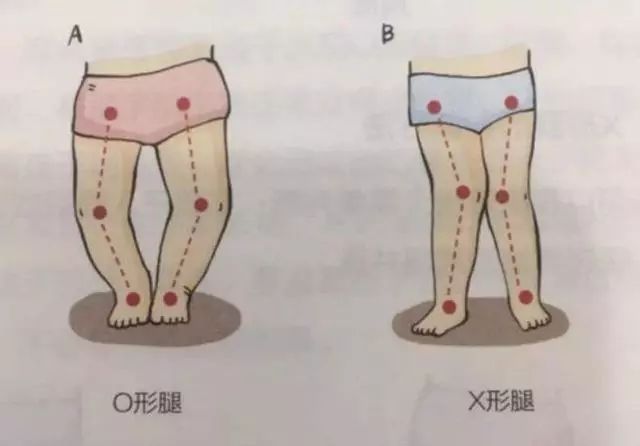 多数的"o型腿"是出生后造成的,造成宝宝o型腿的误区